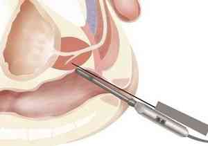 Биопсия шейки матки: радиоволновая, прицельная, петлевая, ножевая